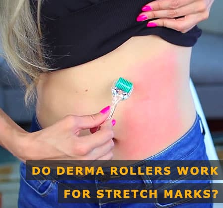 How to Use a Derma Roller For Stretch Marks
